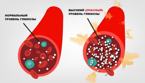 Предиабет: когда все еще кажется безопасно, но здоровье под угрозой